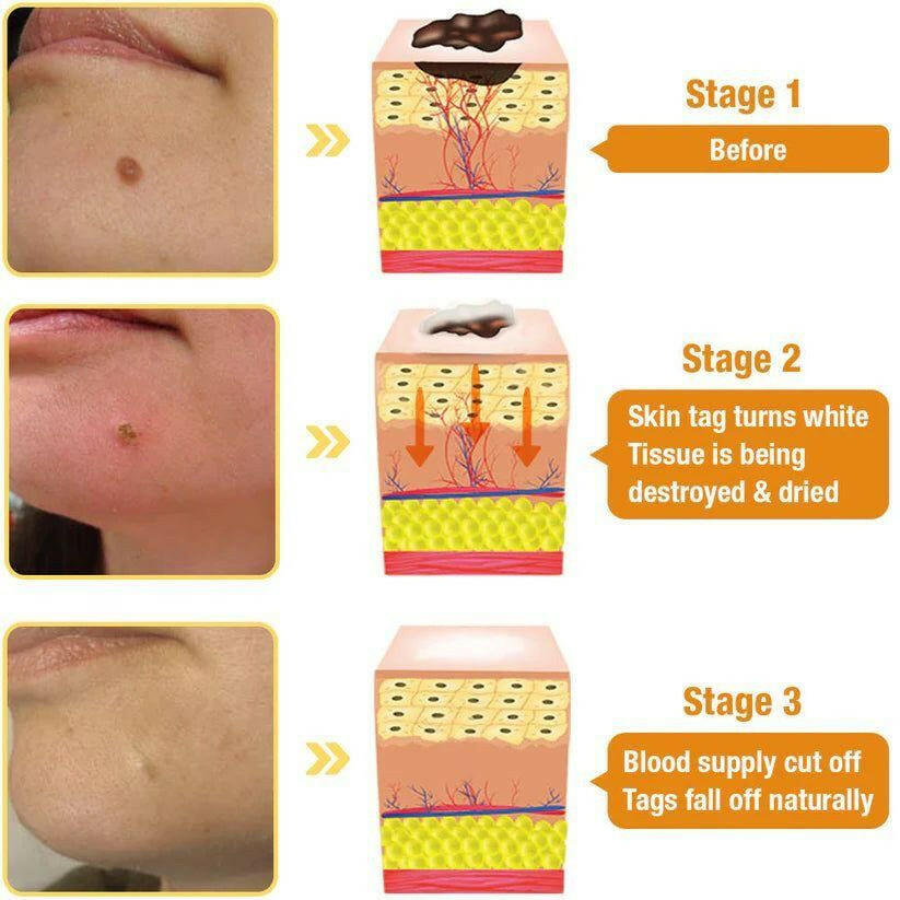 Dmart Online Bee Venom Wart Remover Spray